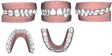 国产牙套评测视频大全下载,全方位解析各类热门矫正器